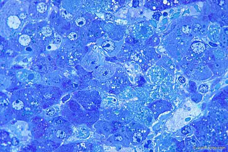 Iowa resident dies of suspected Lassa fever: What is the rare viral disease?