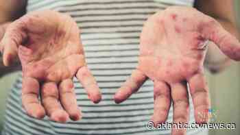 Measles cases in New Brunswick more than double in three days