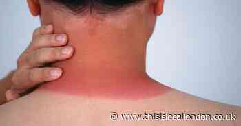 London’s sunburn hotspot revealed