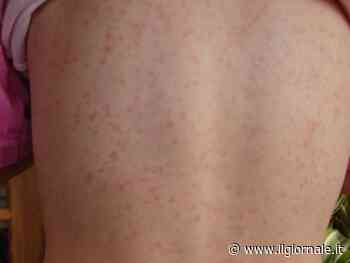 Scarlattina, prevenzione e cure: quali sono i sintomi e le modalità di contagio