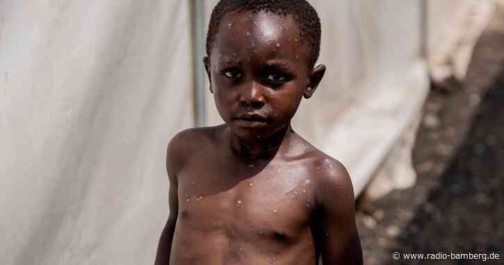 WHO: Mpox-Ausbruch weiter gesundheitliche Notlage