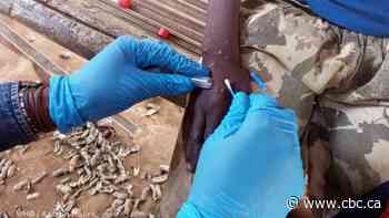 Manitoba detects 1st confirmed case of recently identified mpox strain in Canada