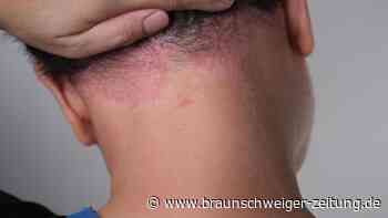 Hautpilz-Erkrankungen: Experte warnt vor gefährlichen Erregern