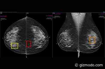 AI Is Detecting More Breast Cancer Cases, Study Suggests