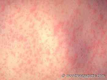 Hundreds may have been exposed to measles during November NATO conference in Montreal