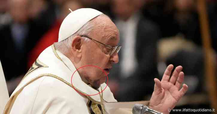 Il Papa e il vistoso ematoma sul collo: “Ha battuto il mento sul comodino”