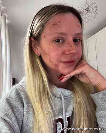 Party girl claims she's in 'living nightmare' after quitting steroid cream