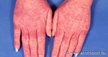 Kutaner Lupus erythematodes erhöht Herz-Kreislauf-Risiko