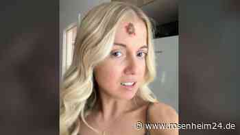 Harmloser „Pickel“ bei junger Frau erweist sich als Krebs – „Es war ein Schock“