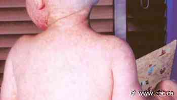 AHS alert: Measles exposure at Calgary hospital, airport and grocery store