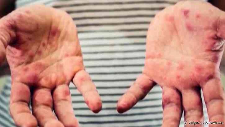 Measles exposure possible in Calgary after lab-confirmed case: AHS