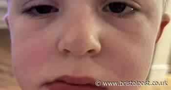 Warning after boy, five, almost died licking eyedrop off his cheek
