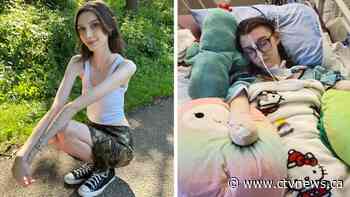 This Canadian teen lost her hands and feet to an infection. She's on a mission to share her story