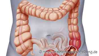 Studie legt nahe: Beliebtes Lebensmittel soll Risiko für tückischen Darmkrebs möglicherweise senken