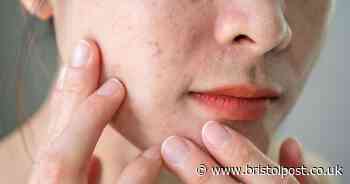 Woman's 'one day rule' can to see if you'll get acne from trying new products