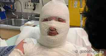 ‘She lit him on fire’: Victim’s father says Vancouver incident was deliberate