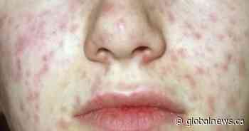 Ontario public health units issue measles warnings about 2 emergency rooms, walk-in clinic