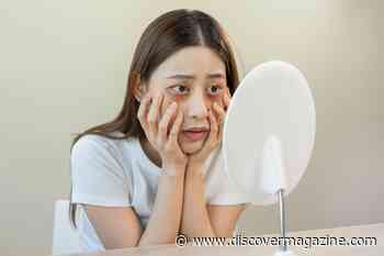 Why We Get Dark Circles Under Our Eyes and How to Treat Them