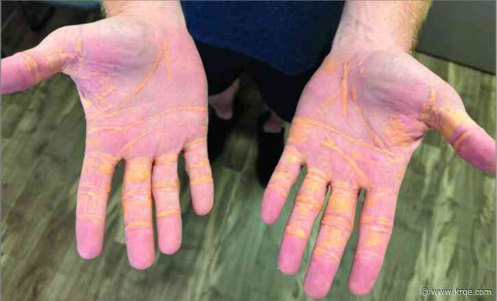 Man's hands filled with cholesterol after he ate pounds of cheese, butter for months