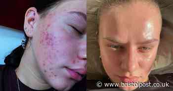 Woman's acne woke her at night until one moment 'changed everything'