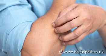 UK reports new 'more contagious' mpox case as NHS outlines protection steps