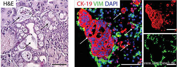1,25 Mio. Euro für Bauspeicheldrüsen-Krebsforschung an der Uniklinik Ulm