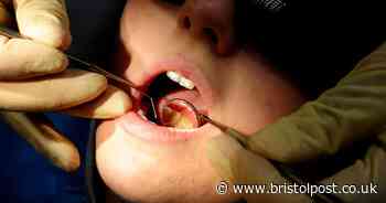 More than one in four five-year-olds in Bristol have tooth decay