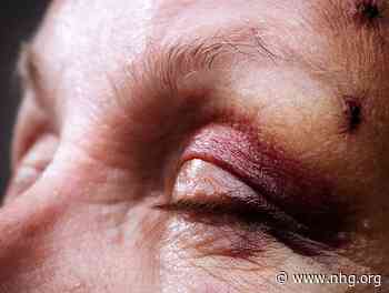 Herzien: NHG-Standaard Hoofdtrauma