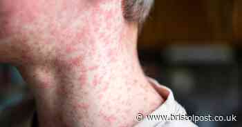 UKHSA issues warning as Bristol has highest levels of 'serious' infection