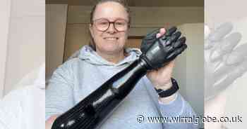 Woman born with one hand has life ‘transformed’ after treatment at Wirral hospital