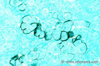 mRNA vaccines show promise against pancreatic cancer in early trial  