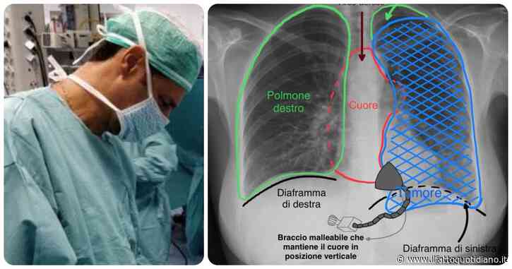 Un “bacio” lungo 10 ore a un cuore sollevato, così alle Molinette di Torino hanno asportato un tumore
