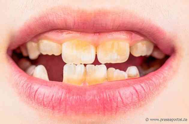 Neue Erkenntnisse: Zusammenhang zwischen Kreidezähnen und Parodontitis bei Jugendlichen