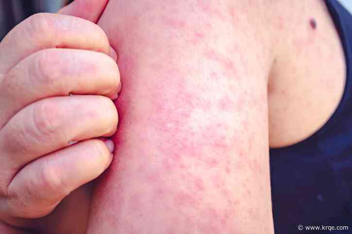 Measles count rises to 9 in Lea County