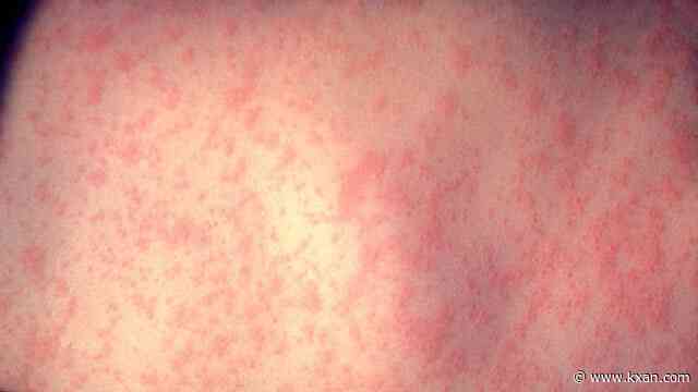 Texas measles outbreak: 90 cases in state as of Friday