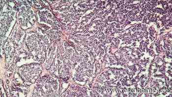 Metastasenbildung stoppen: Forscher kreieren neues Mittel im Kampf gegen Krebs