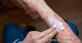 Water issue could ‘worsen symptoms’ behind common skin condition