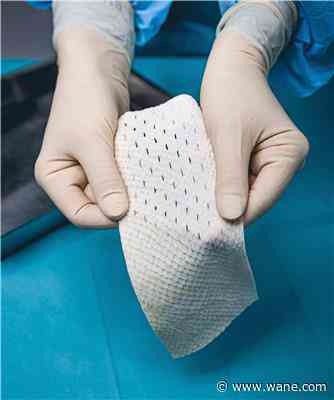 No fish tale: Parkview nurse receives international award for using cod skin grafts