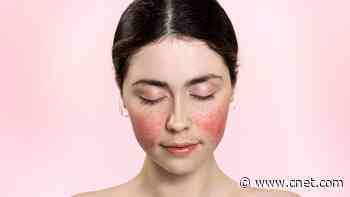 Rosacea: Symptoms, Causes and 5 Skincare Treatment Tips