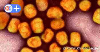 40 Fälle von Mpox in SH seit 2022: So überstand Mann aus Kiel „Affenpocken“