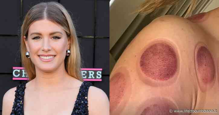“La coppettazione non è uno scherzo”: l’avvertimento di Eugenie Bouchard che mostra gli impressionanti segni della terapia