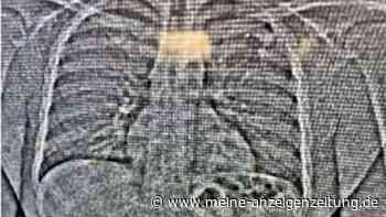 US-Polizei: Dieb verschluckt 769.500 Dollar teure Ohrringe