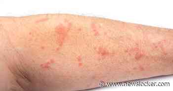 Patiënt met zeer besmettelijke schurft in Gronings ziekenhuis