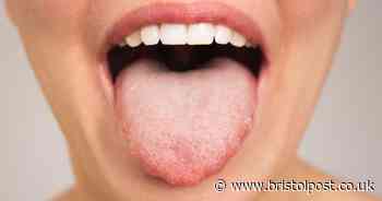 NHS shares tongue symptom which could mean you're anaemic