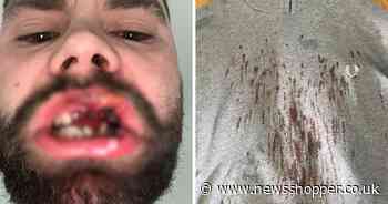 'I lost my teeth in a random Kent pub attack - now my child won't look at me'