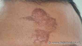 Mystery as churchgoers' foreheads are BURNED after receiving mark of the cross on Ash Wednesday