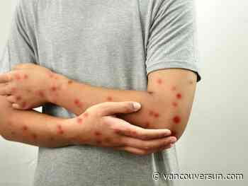 Health officials confirm two more cases of measles in Metro Vancouver