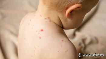 Concern grows as measles spread across Alberta