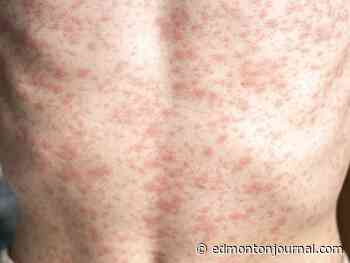 AHS alert: Edmonton measles cases confirmed, exposure sites include northside clinic, Stollery Children's Hospital