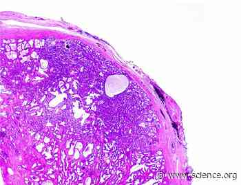 The kinase PLK1 promotes Hedgehog signaling–dependent resistance to the antiandrogen enzalutamide in metastatic prostate cancer | Science Signaling